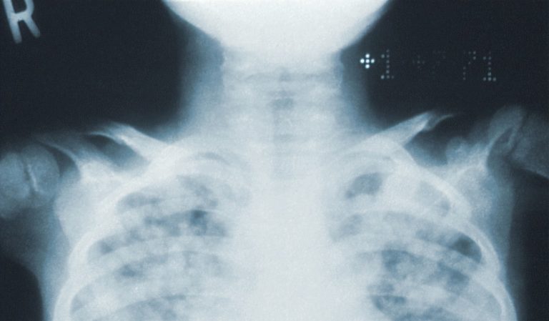 X-ray of chest