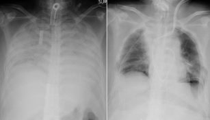 Lung transplant x-ray