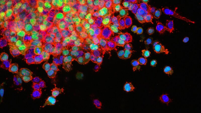 Lung cancer metastasis