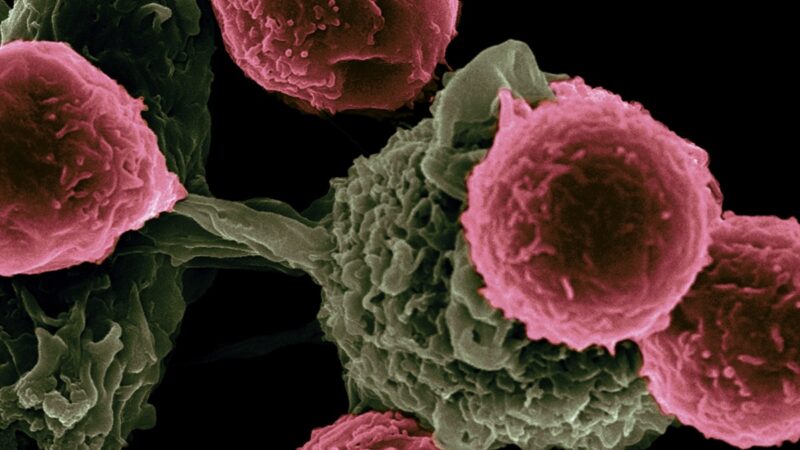 Cancer cells under microscope