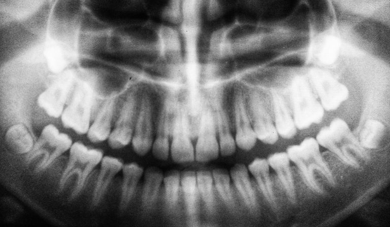 X-ray of teeth