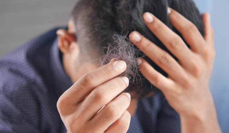 Person with alopecia